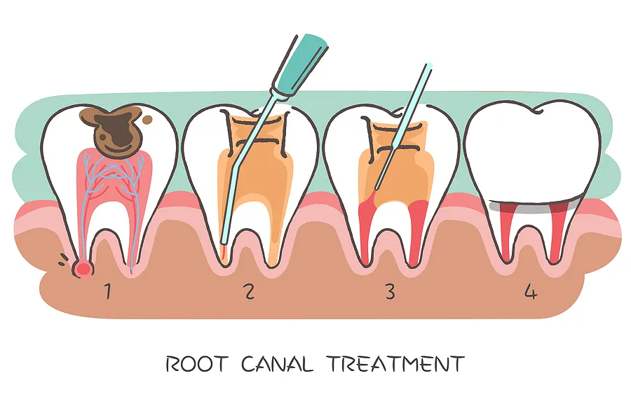 Understanding Periodontal Disease: Causes, Symptoms, and Treatment