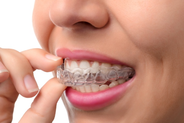Invisalign: The Invisible Path to a Confident Smile Transformation