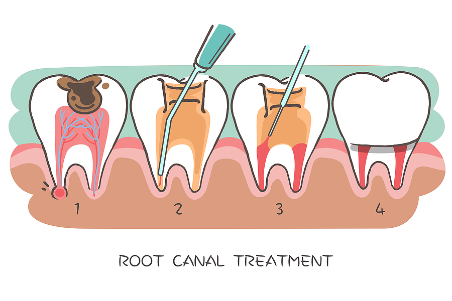 Understanding Root Canal Therapy: A Vital Treatment for Saving Teeth